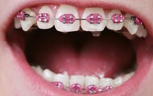 baces with dry mouth